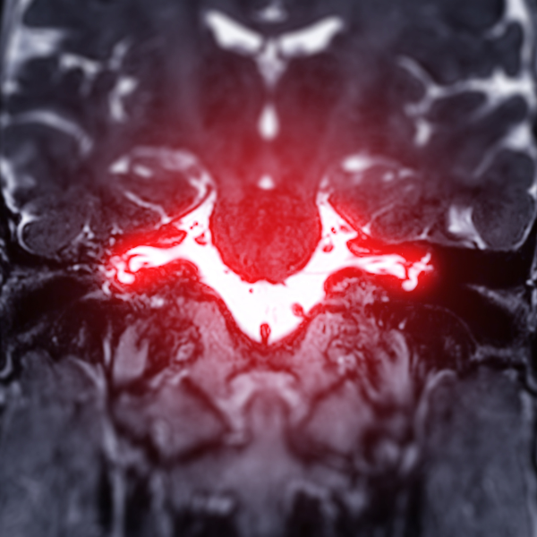 Management of Acute Dizziness and Vertigo